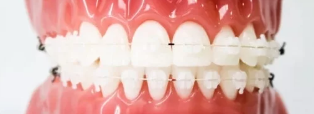 تقويم الأسنان: دليلك الشامل لتحسين ابتسامتك وصحة فمك