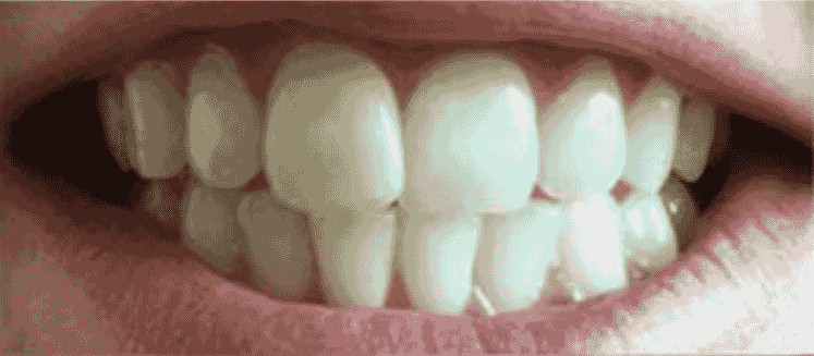 Avant — Blanchiment dentaire WHITECARE
